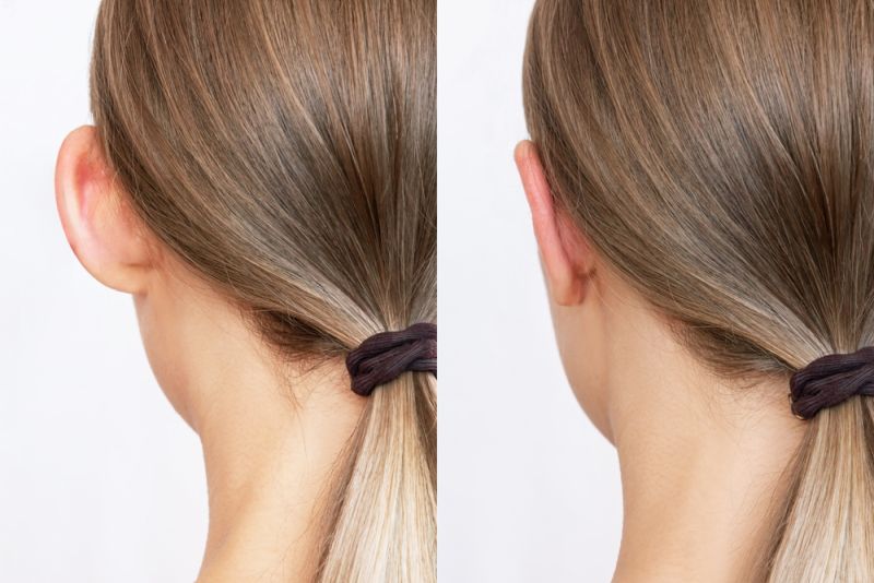 Ear Reconstruction